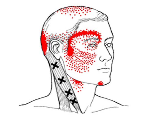 fisiokinesis-corso-trigger-point